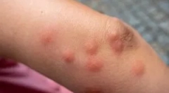 Allergia a claop harapásához