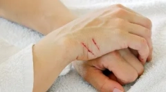 Bites és karcolásokon keresztül továbbított betegségek