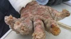 Mi a veszélyes fililrosis: tünetek és kezelés