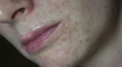 Demodecosis: mi az, a tünetek és a kezelés