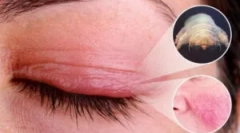 Demodecosis: okok, tünetek és kezelés