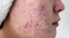 Hogyan továbbítják a demodikózis?