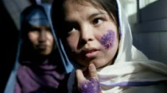 Hogyan lehet fertőzni a leishmeni-val: a leishmaniis tünetei és kezelése