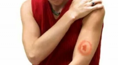 Tick-borne borreliosis kezelése