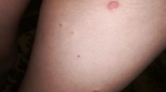 Miért harapnak bolhákokat, és nincsenek mások