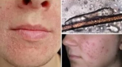 Szállítási elemzés a demodecózisról