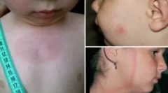 A korreliózis tünetei és kezelése gyermekben