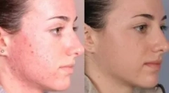 A demodikózis kezelésére szolgáló eszközök