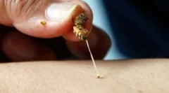 Az egyesült királyság harapásokból származó pénzeszközök