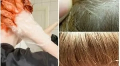 A tetvek hajfestése megöli?