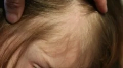 Tetvek és rövidnadrág a hajában egy gyermekben